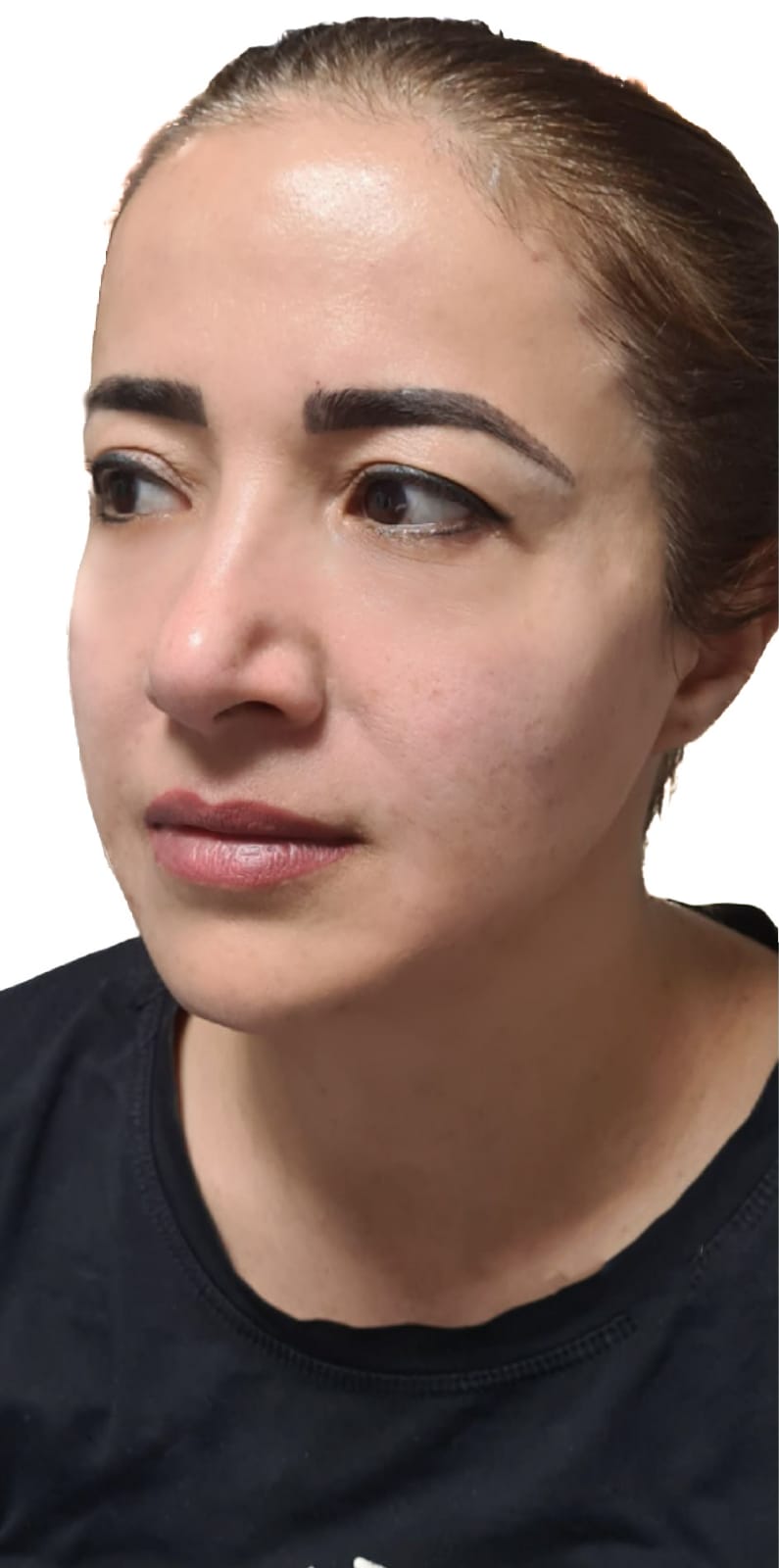 פיסול פנים אחרי